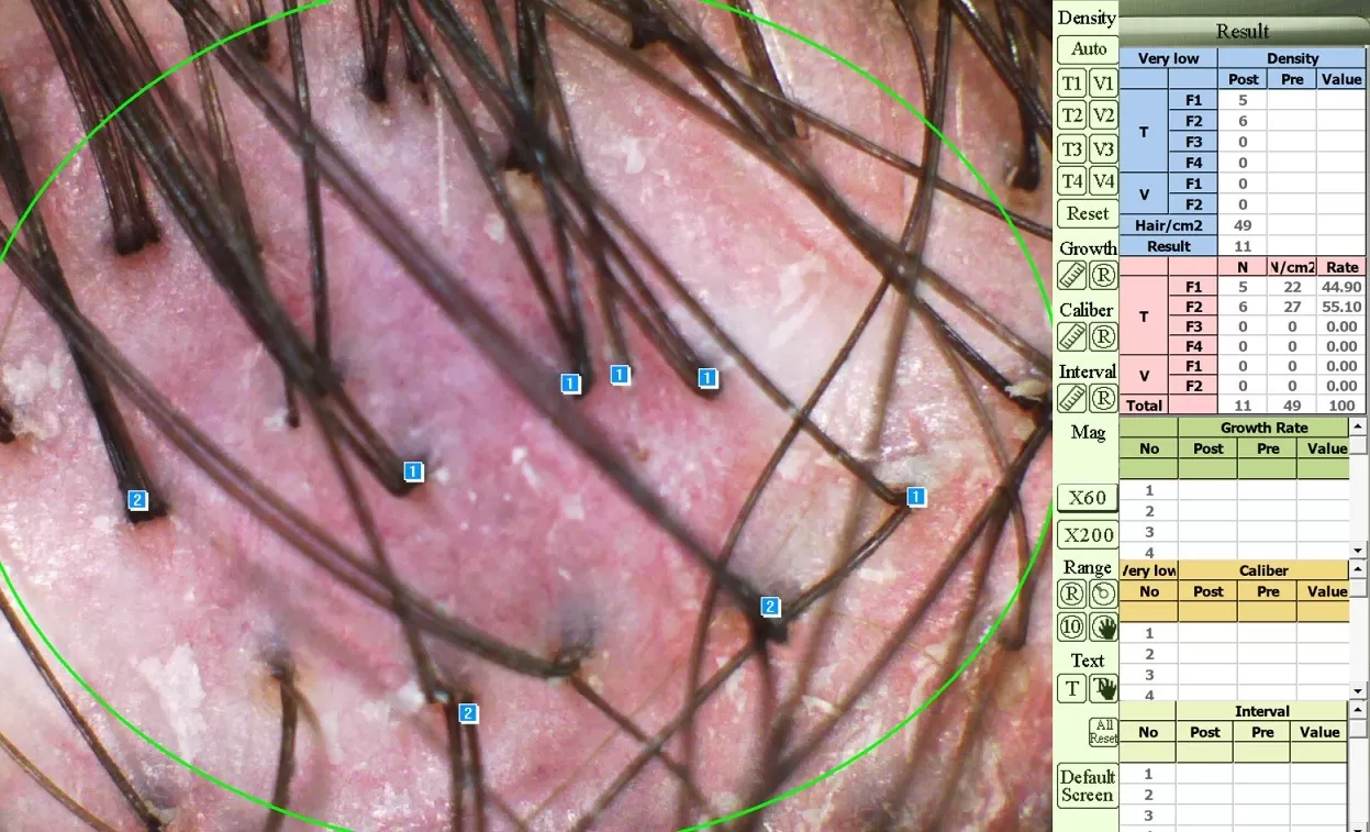 Trichoskopia badanie skóry głowy